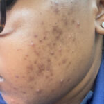Acne Skin Kit photo review