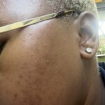 Acne Skin Kit photo review