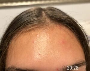 ACNIGUARD Gel Moisturizer photo review